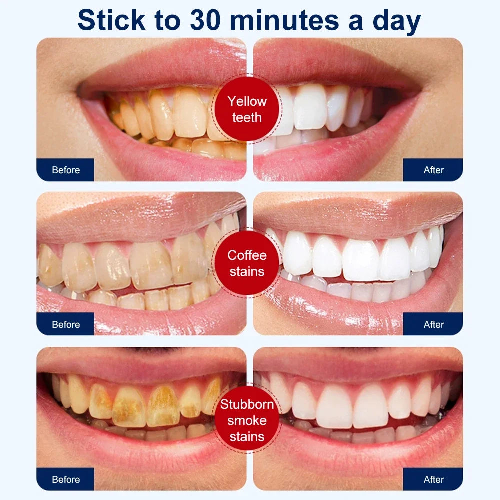 5D Teeth Whitening Strips Gel