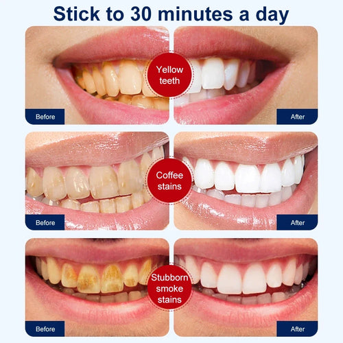 5D Teeth Whitening Strips Gel